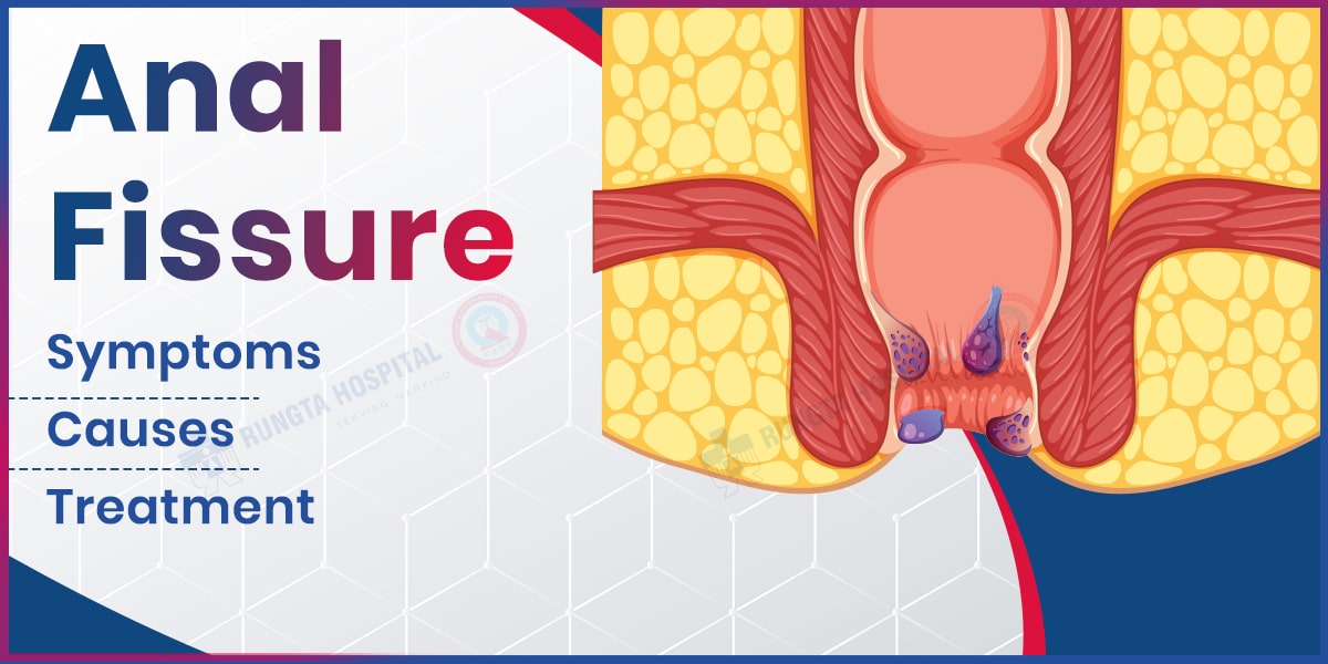 Anal Fissure: What It Is, Symptoms, Causes & Treatment